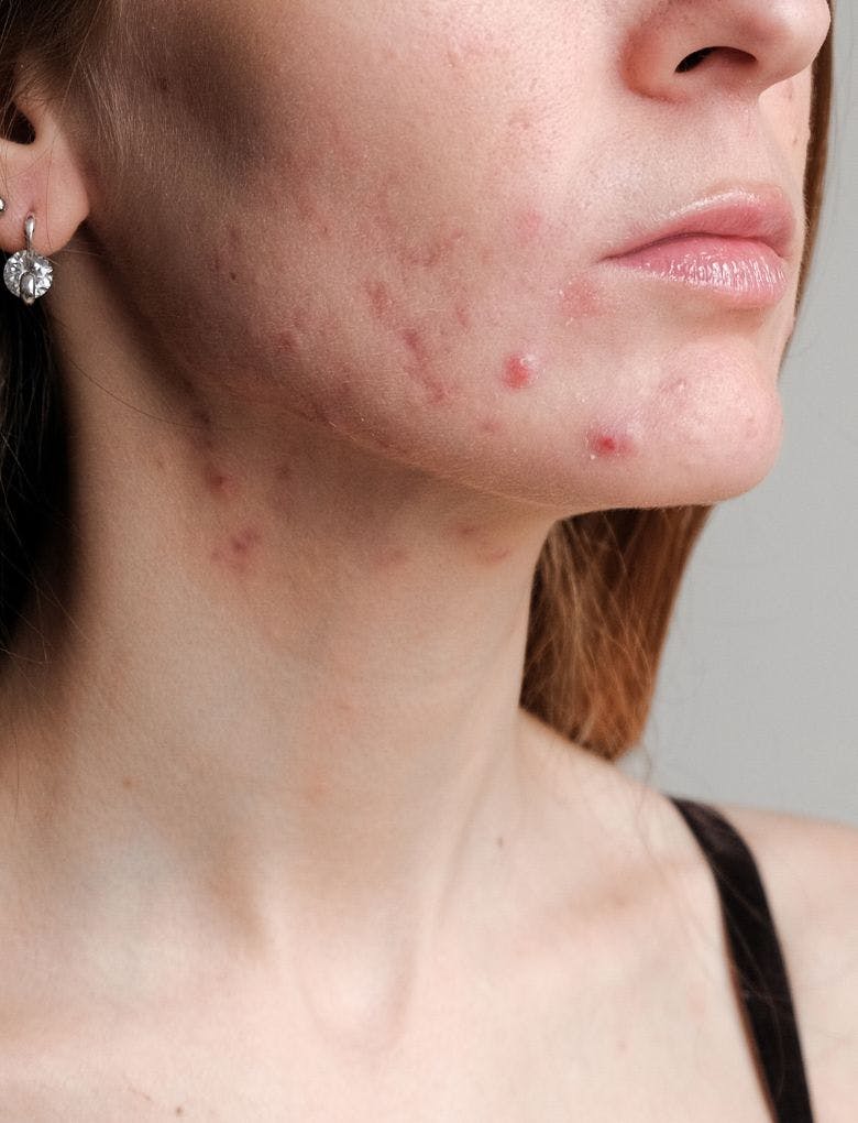girl with hormonal acne and scars 