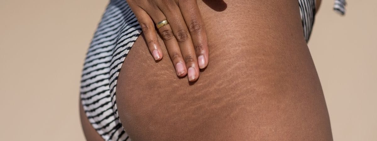 What Can Help with Stretch Mark Removal: The Products To Try At Home