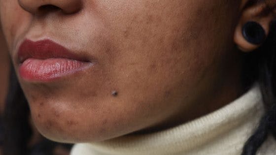 Base 101: How to Make Foundation Look Natural on Acne