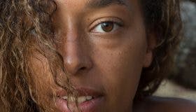 What Causes Hyperpigmentation And How Do You Get Rid Of It?