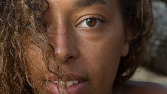 What Causes Hyperpigmentation And How Do You Get Rid Of It?