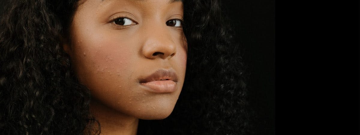 How To Deal With Your PCOS Acne, According To Experts 